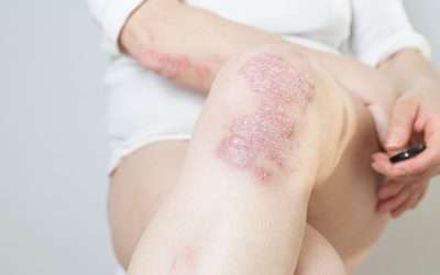 Looking at Psoriasis